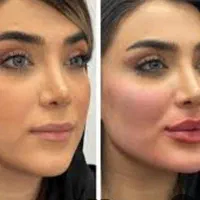تخفیف ویژه تا ۶ شهریور فیلربادی سینه بیکینی باسن