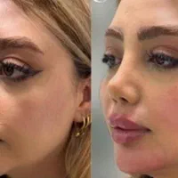اموزش پزشک متخصص ژل.فیلر‌بوتاکس.لیفت نخ.ساکشن غبغب|خدمات آموزشی|مشهد, سناباد|دیوار