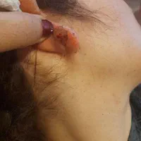درمان گوشت اضافه  بر اثر سوختگی وچاقو، غیره|خدمات آرایشگری و زیبایی|کوهدشت, |دیوار