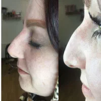 لیفت بینی بانخ|خدمات آرایشگری و زیبایی|تبریز, |دیوار