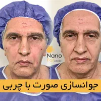 تزریق چربی صورت دست با سن بیکینی در کلینیک تخصصی|خدمات آرایشگری و زیبایی|تهران, صادقیه|دیوار