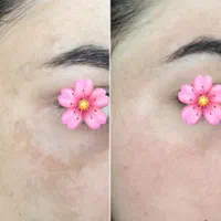 لیزر کک مک خال لیفت لمینت پاکسازی مژه ناخن ژل|خدمات آرایشگری و زیبایی|خرم‌آباد, |دیوار