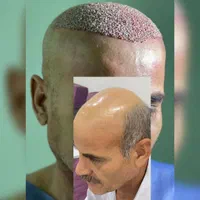 کاشت مو ابرو و ریش تارکوب|خدمات آرایشگری و زیبایی|کرج, عظیمیه|دیوار