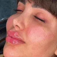 تزریق ژل و بوتاکس و فیلر زیر چشم ،نخ ،مزو ، آنزیم|خدمات آرایشگری و زیبایی|کرج, گوهردشت|دیوار
