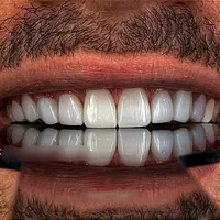 کامپوزیت دندان لمینت عصب کشی دندانپزشکی بوتاکس|خدمات آرایشگری و زیبایی|کرج, فاز ۱ مهرشهر|دیوار