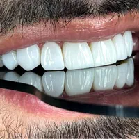 کامپوزیت دندان روکش دندان ایمپلنت کره ای اوردنچر|خدمات آرایشگری و زیبایی|تهران, ستارخان|دیوار