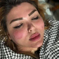 ژل بوتاکس،بلفاروپلاستی،پی آر پی،فیشیال ساکشن غبغب|خدمات آرایشگری و زیبایی|تبریز, |دیوار