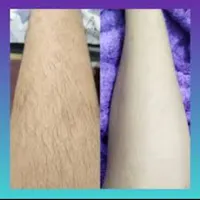 مدل اپیلاسیون