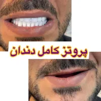 دندان مصنوعی/ دست دندان/ ژله ای/ چکی|خدمات آرایشگری و زیبایی|کرج, چهارصد دستگاه|دیوار