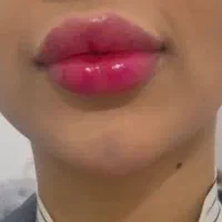 تزریق ژل،بوتاکس،خال برداری،مزوی مو و صورت|خدمات آرایشگری و زیبایی|بندر کنگان, |دیوار