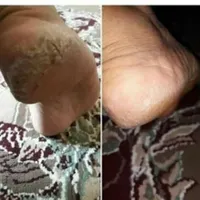 کرم ترک پا
