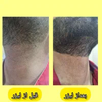 کلینیک تخصصی لیزر موهای زائد(الکساندرایت آمریکای)|خدمات آرایشگری و زیبایی|خرمشهر, |دیوار