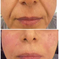 ژل بوتاکس فیلر مزوتراپی پیرسینگ و آموزش حرفه ایی|خدمات آرایشگری و زیبایی|قم, هنرستان|دیوار