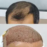 کاشت مو، ابرو، ریش حرفه ای توسط پزشک متخصص پوست مو|خدمات آرایشگری و زیبایی|شیراز, قدوسی غربی|دیوار