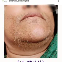 تخفیف الکترولیز،(×لیزر نیست) حذف دائم موهای زائد|خدمات آرایشگری و زیبایی|یاسوج, |دیوار