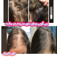 پی آرپی مو وصورت وبوتاکس آف خورده|خدمات آرایشگری و زیبایی|کرمانشاه, |دیوار