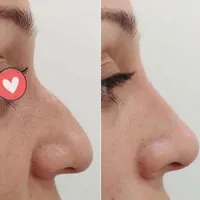 آنزیم ترکیبی بینی گوشتی،لیفت بینی،ژل لب،مزوتراپی|خدمات آرایشگری و زیبایی|تهران, سعادت‌آباد|دیوار