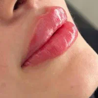 جشنواره فیلر ژل لب چال لپ کاشت نگین دندان پیرسینگ
