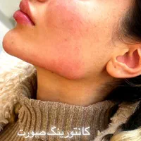 تزریق فیلر صورت مطابق المانهای زیبایی شناسی|خدمات آرایشگری و زیبایی|ورامین, |دیوار
