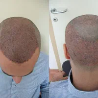 کاشت مو ابرو درمرکزجراحی بیمارستانی نه کلینیک ومطب|خدمات آرایشگری و زیبایی|تهران, فردوسی|دیوار