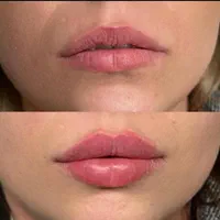 تزریق ژل،ژل لب روسی تخصصی،بوتاکس