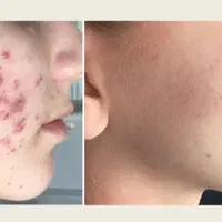 جوش و تیرگی صورت ، ریزش مو ، جوانسازی پوست|خدمات آرایشگری و زیبایی|رفسنجان, |دیوار