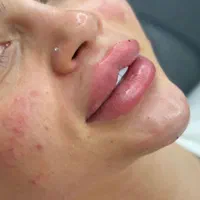 تزریق ژل و بوتاکس هایفو لیزر پلاسما|خدمات آرایشگری و زیبایی|تهران, ستارخان|دیوار