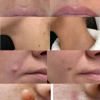 خال برداری کاملا بهداشتی وباوسایل یک بار مصرف|خدمات آرایشگری و زیبایی|قم, امامزاده ابراهیم|دیوار