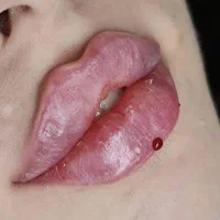 تزریق ژل لب زاویه سازی لیزر بوتاکس۱۰۰ درصد تضمینی|خدمات آرایشگری و زیبایی|تهران, ستارخان|دیوار