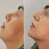 تزریق ژل و بوتاکس و کاشت نخ در کلینیک زیبایی|خدمات آرایشگری و زیبایی|خرم‌آباد, |دیوار