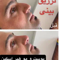 جشنواره تخفیف عیدانه تزریق ژل آنزیم جالپرو لیزر|خدمات آرایشگری و زیبایی|تهران, ستارخان|دیوار