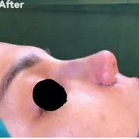 جراحی زیبایی بینی (جشواره)|خدمات آرایشگری و زیبایی|تهران, صادقیه|دیوار