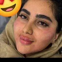 تزریق انواع ژل وبوتاکس(تخفیفات ویژه)