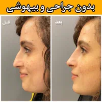فرم دهی بینی بدون جراحی و بیهوشی رینوپلاستی NOA|خدمات آرایشگری و زیبایی|مشهد, هفت تیر (حافظ)|دیوار