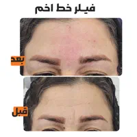 فیلر چروک های صورت