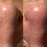 پاکسازی پوست تخصصی و اموزش تخصصی پاکسازی پوست|خدمات آرایشگری و زیبایی|کرمانشاه, |دیوار