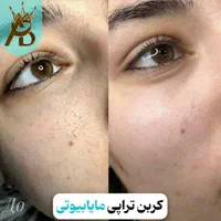 روشن کننده صورت بیکینی ،کربن تراپی تخصصی مابیوتی|خدمات آرایشگری و زیبایی|یاسوج, |دیوار