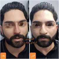 تزریق آنزیم بینی/فیلر بینی/شقیقه/ژل/درکلینیک پزشکی|خدمات آرایشگری و زیبایی|شیراز, زرهی|دیوار
