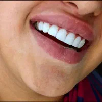 کامپوزیت زیبایی دندانپزشکی|خدمات آرایشگری و زیبایی|یاسوج, |دیوار