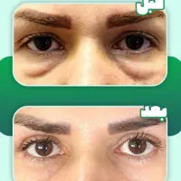 درمان قطعی و جوانسازی گودی .تیرگی و چروک زیر چشم|خدمات آرایشگری و زیبایی|مشهد, سناباد|دیوار