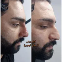 تزریق آنزیم بینی/فیلر بینی/شقیقه/ژل/درکلینیک پزشکی|خدمات آرایشگری و زیبایی|شیراز, زرهی|دیوار