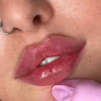 مطب ژل وبوتاکس لب لیفت با نخ رفع گودی چشم جدید|خدمات آرایشگری و زیبایی|گرگان, |دیوار