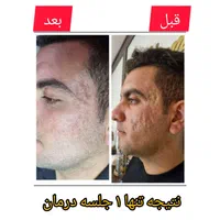 درمان تضمینی وماندگار تو رفتگی پوستی/جای جوش/اسکار|خدمات آرایشگری و زیبایی|اصفهان, باغ دریاچه|دیوار