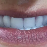 دندان مصنوعی/ دست دندان/ ژله ای/ چکی|خدمات آرایشگری و زیبایی|کرج, چهارصد دستگاه|دیوار