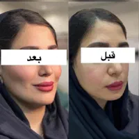 ژل لب بوتاکس لیزر فیلر هایفوبلفاروپلاستی|خدمات آرایشگری و زیبایی|مشهد, فرهنگ|دیوار