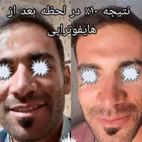 لاغری با دستگاه پاکسازی فیشال هایفو تراپی|خدمات آرایشگری و زیبایی|زنجان, |دیوار
