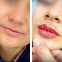 تزریق ژل و فیلر و بوتاکس و نخ لیفت و پی آرپی و ...