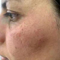 آموزش تخصصی کرم پودرفشیال مزونیدل اسکالپ سر وخدمات|خدمات آرایشگری و زیبایی|مشهد, جانباز|دیوار