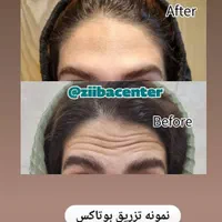تزریق بوتاکس طبیعی