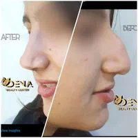 (کلینیک دنا) آنزیم لب و کوچککردن بینی